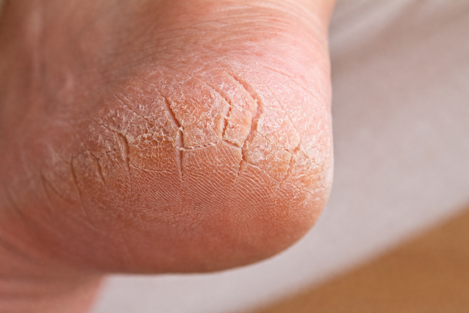かかとがガサガサな男性へ｜50代おっさんがクリームで対処して分かったこと